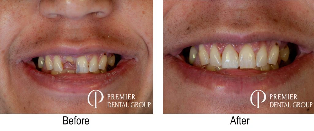 Before And After Of A Crown On A Central Upper Incisor