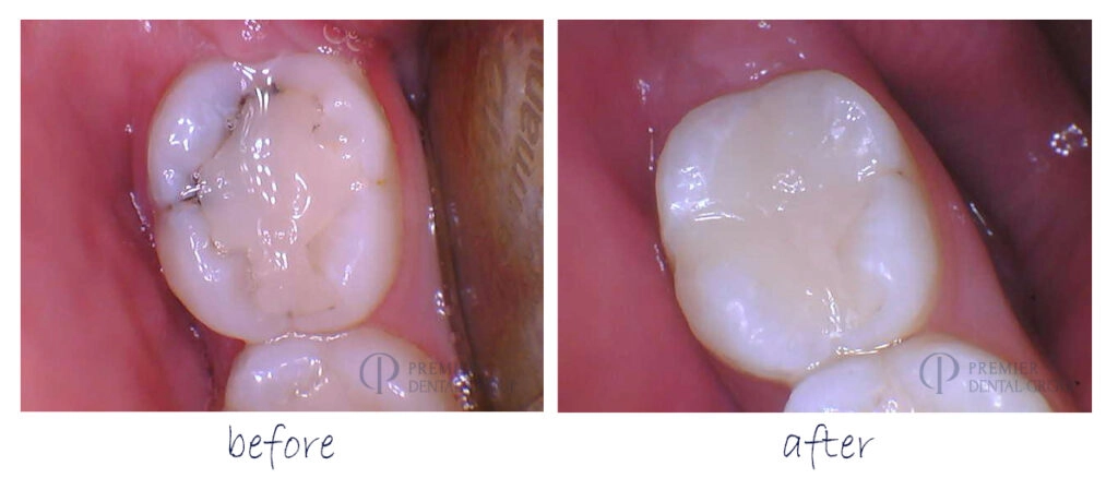Before And After Of A Filling On Top Of A Molar