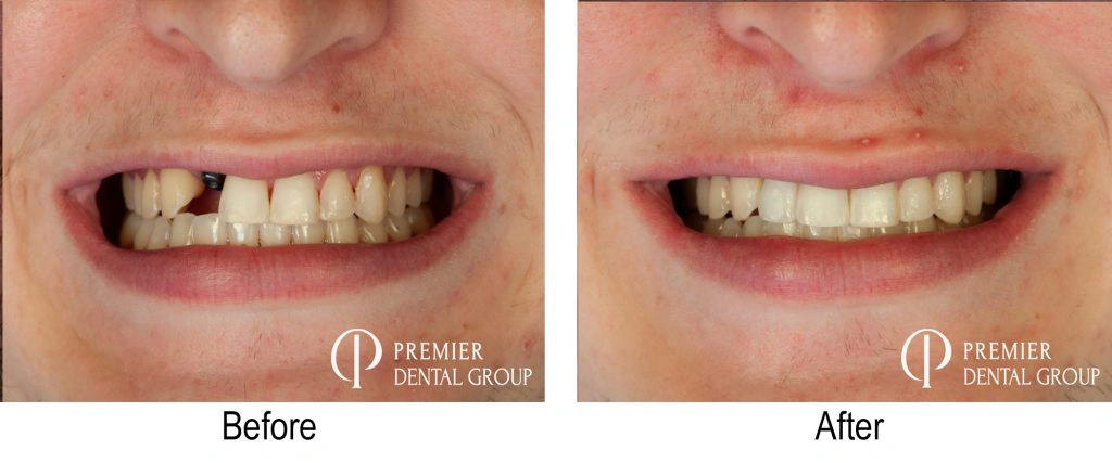 Before And After Of A Patient With An Implant On Their Lateral Incisor