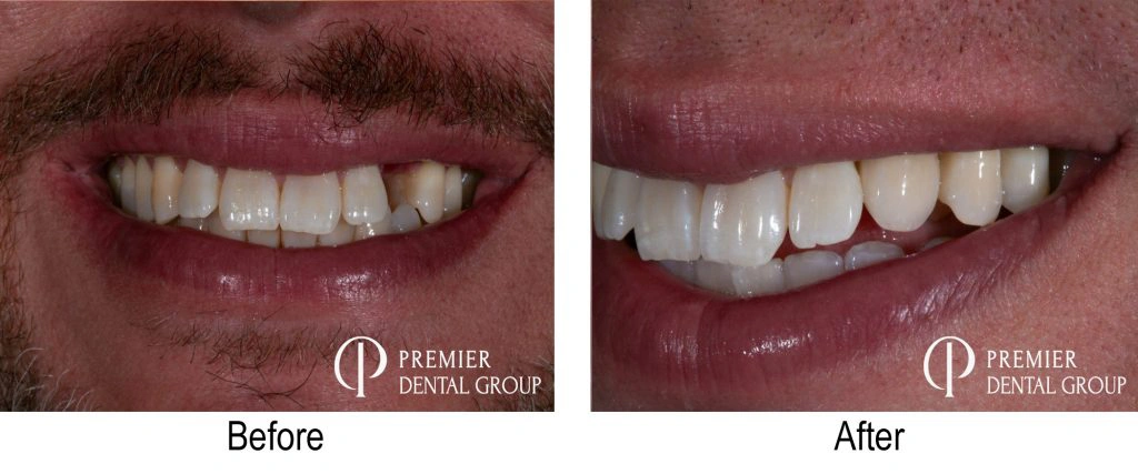 Before And After Of A Patient With An Implant On Their Left Canine Tooth