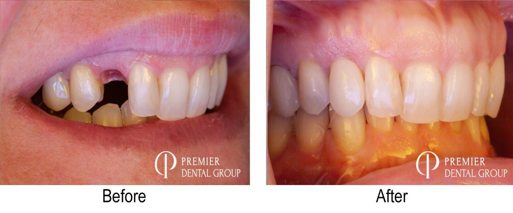 Before And After Of A Patient With An Implant On Their Right Canine Tooth