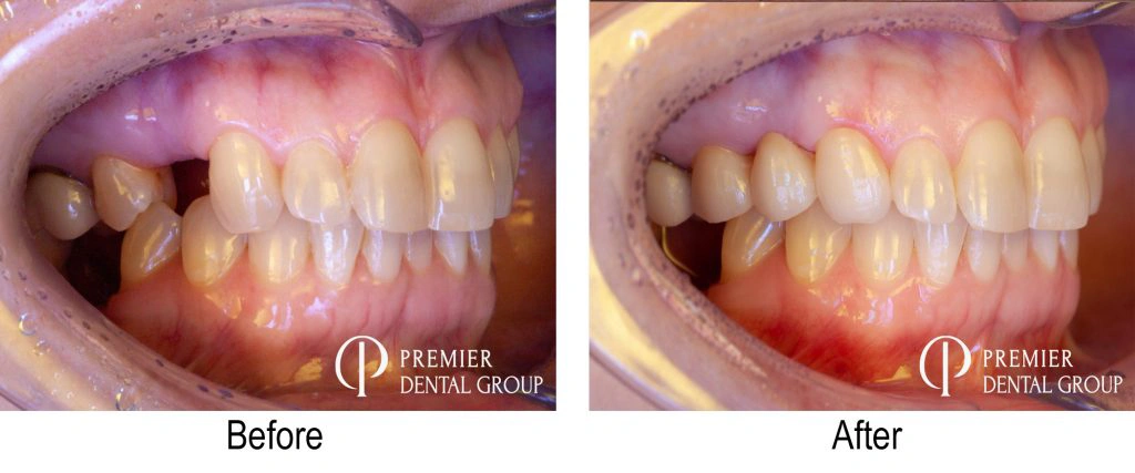 Before And After Of A Patients Dental Bridge Across The First Premolar