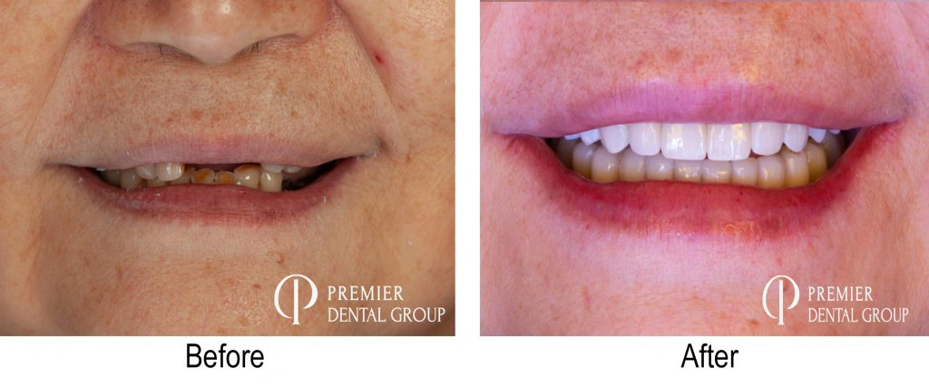 Before And After Of A Patients Smile From Total Mouth Reconstruction