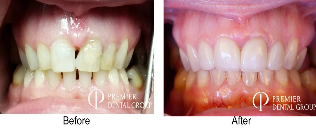Before And After Of Veneers Across The Upper And Lower Arch