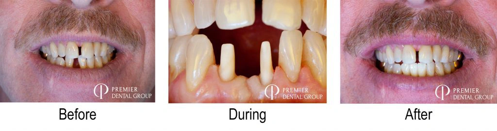 Before, During, And After Of A Patients Dental Bridge Across The Lower Incisors