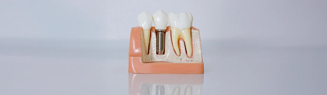 Dental Implants in Portsmouth NH